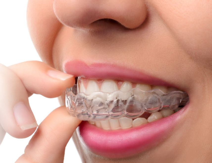 Woman wearing orthodontic silicone trainer